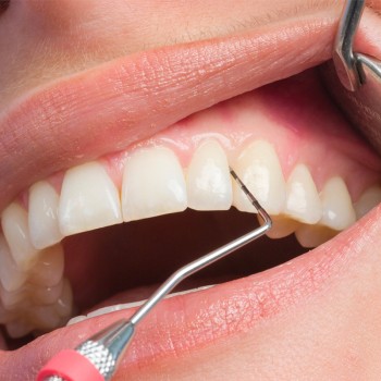 Cos'è lo Screening Parodontale?