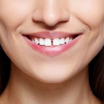 TUTTO SUL DIASTEMA DENTALE E COME CORREGGERLO